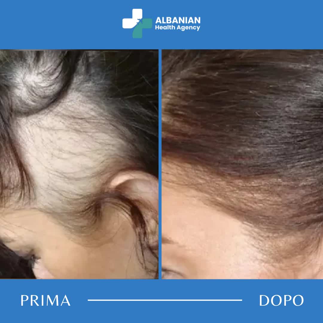 Prima e dopo trattamento diradamento capelli – Albanian Health Agency