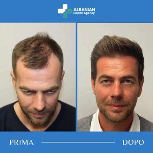 Prima e dopo trattamento capelli – Albanian Health Agency