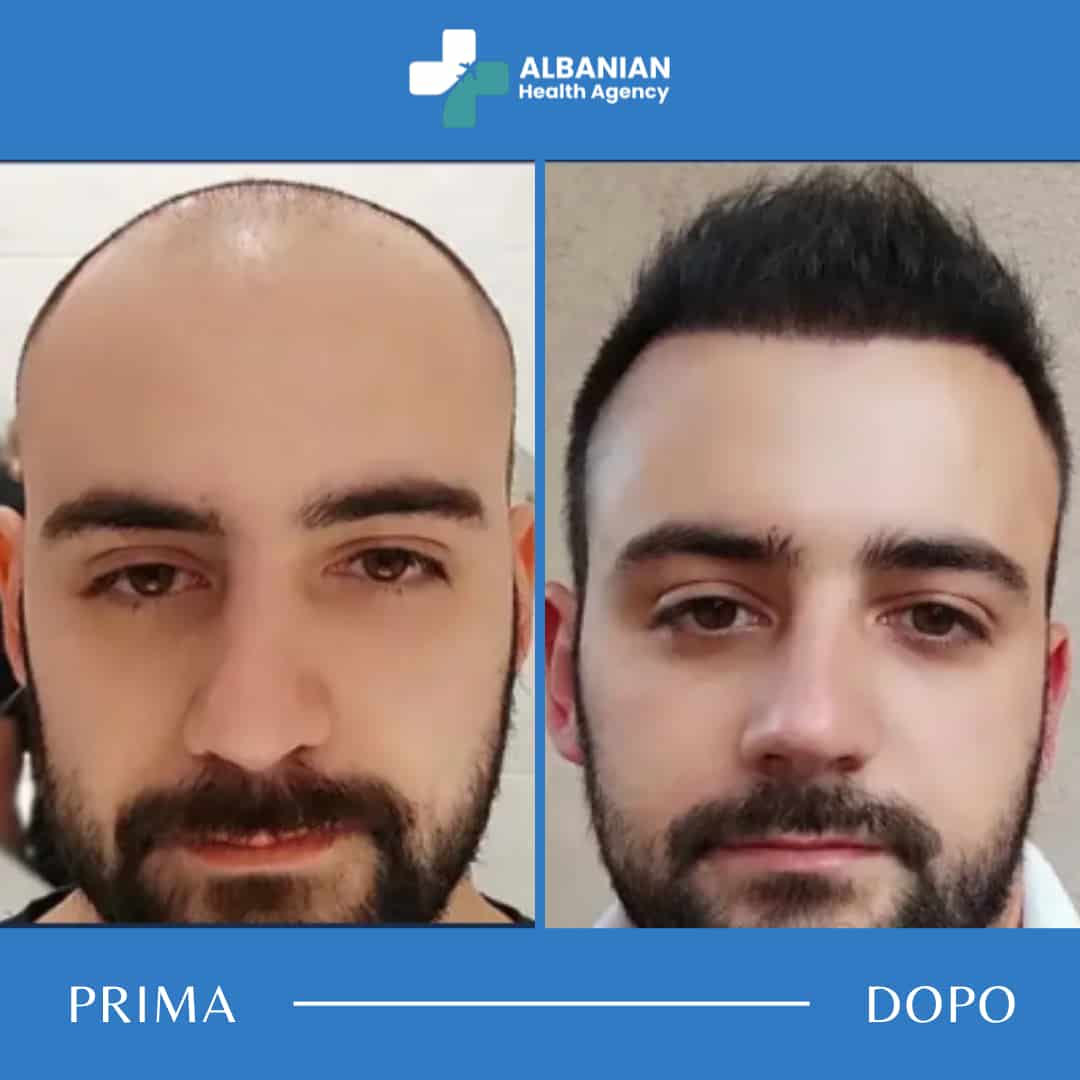 Risultati prima e dopo di un intervento per la ricostruzione della linea frontale in una clinica partner dell’Albanian Health Agency