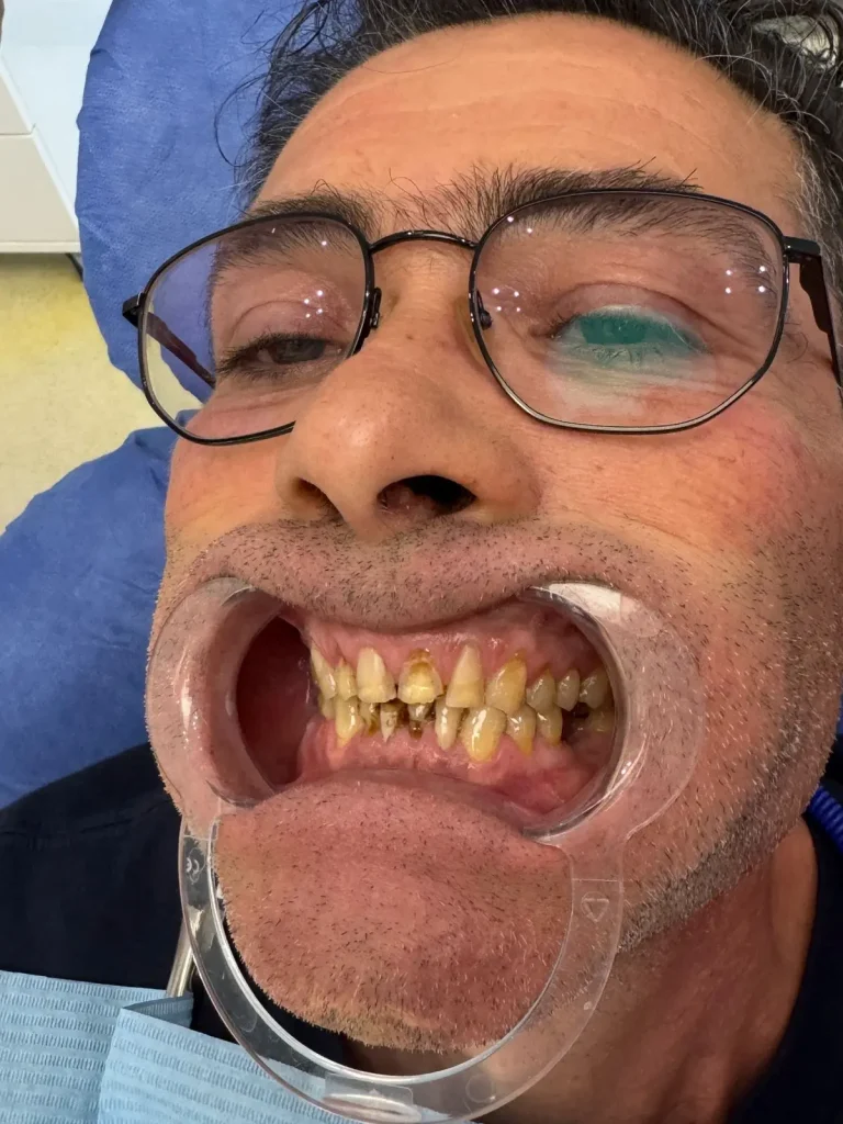 nicola-farina-prima-corone-zirconio-albania