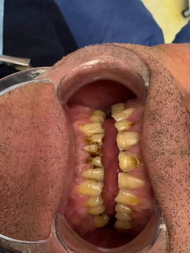 nicola-farina-prima-corone-zirconio-albania