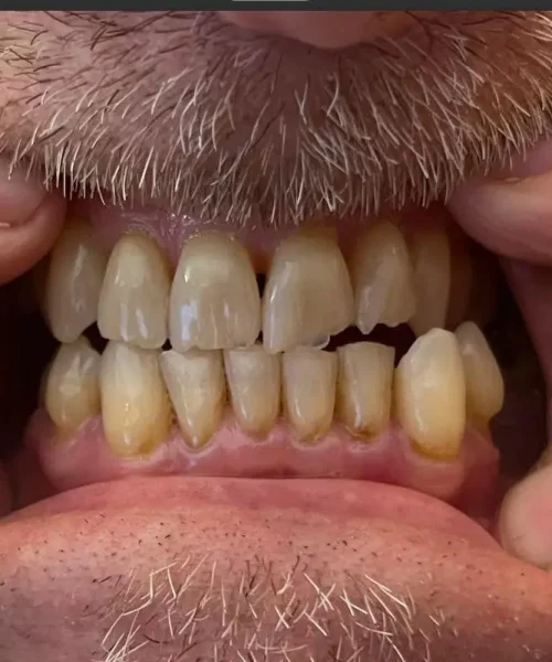 john-willis-prima-all-on-6-albania